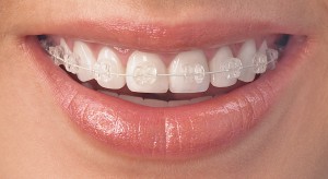 Kieferorthopädie - Feste Zahnspangen, Keramik-Brackets
