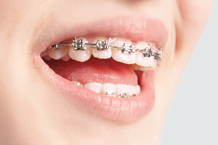 Kieferorthopäde D. Todorovic - Kieferorthopädie für Kinder und Jugendliche, Mini-Brackets