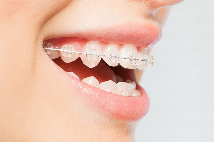 Kieferorthopäde D. Todorovic - Kieferorthopädie für Kinder und Jugendliche, Saphire-Brackets
